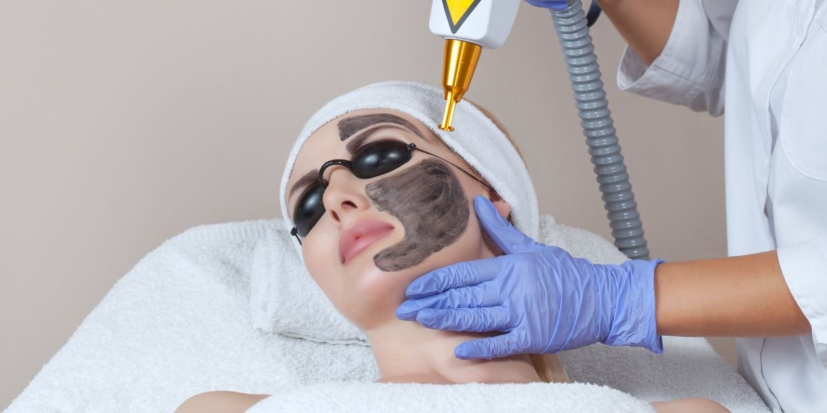 Carbon Laser Facial