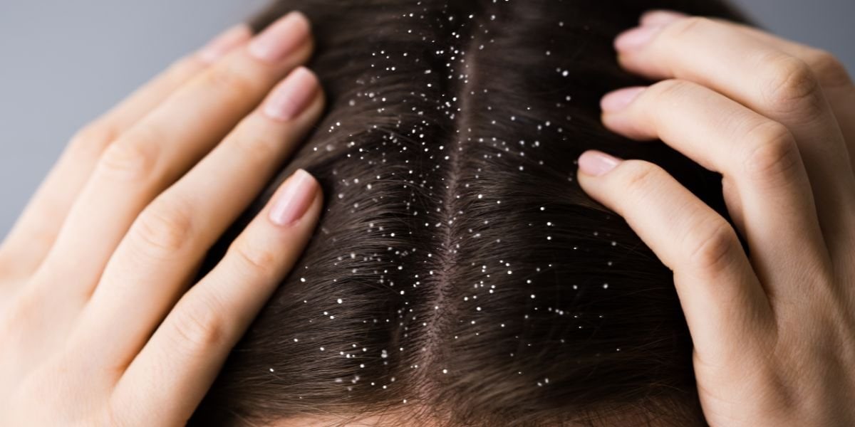 Dandruff Treatment