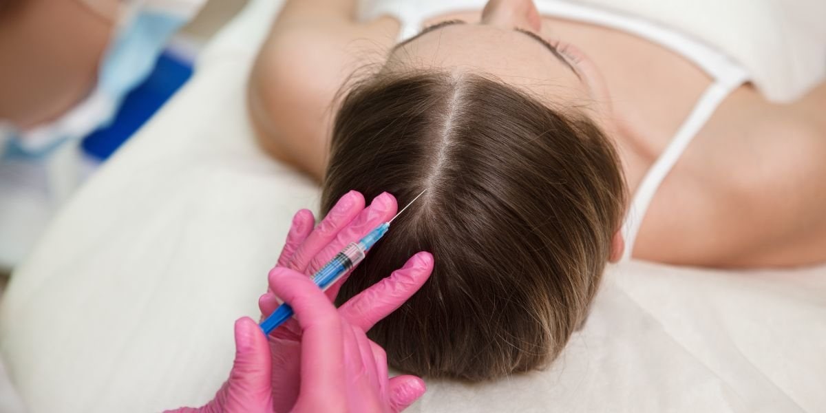 PRP for Hair - Sirpi Site
