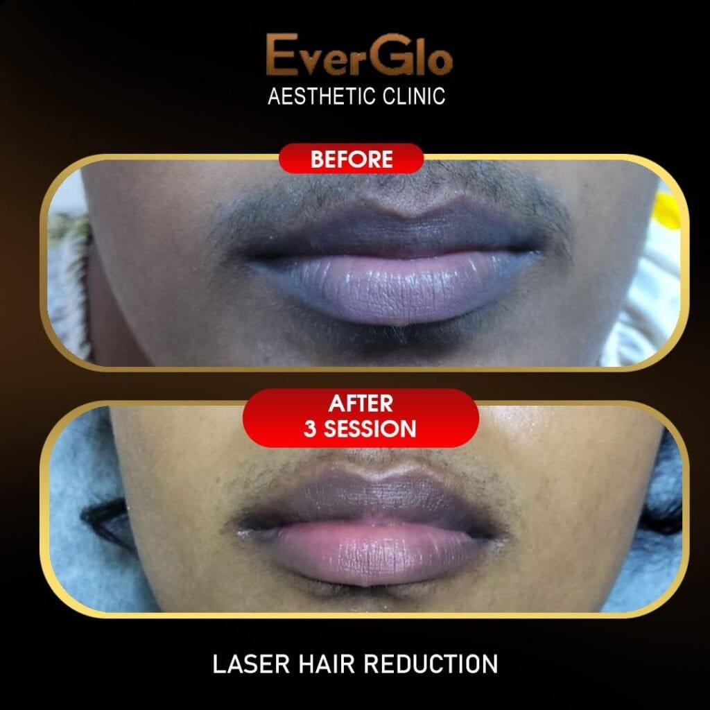Laser Treatment